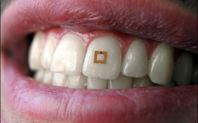 RFID-enabled Tooth Transmits Sensor Data About Diet