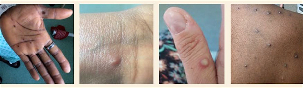 Examples of monkeypox infections