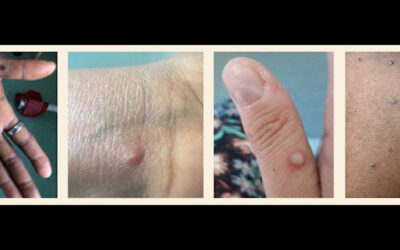 BLE Proximity System Screens for Monkeypox Exposures